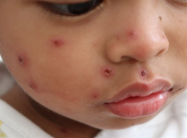 Campak Bukan Sekadar Ruam.